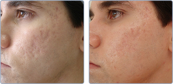 Acne Scar Elimination Before & After