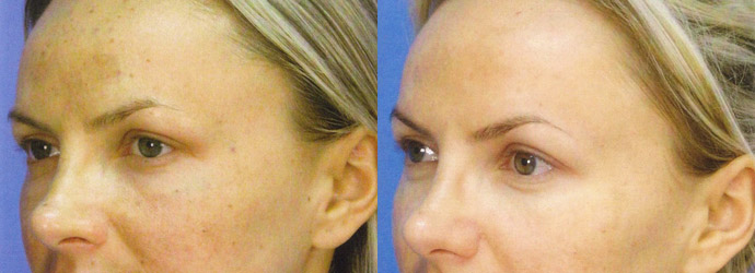 Age Spot Removal Before & After