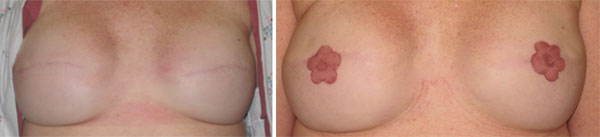 Medical Tattooing Before & After
