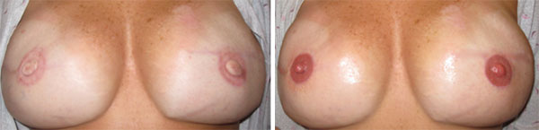 Breast Cancer survivors - Medical Tattooing Before & After