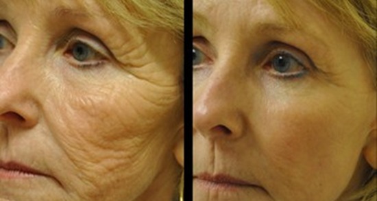 Non-Surgical Facelift Before & After