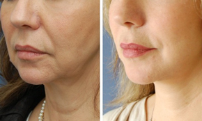 Non-Surgical Neck Tightening Before & After