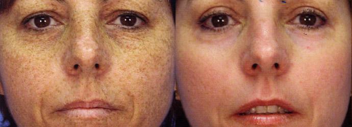 Skin Resurfacing Before & After