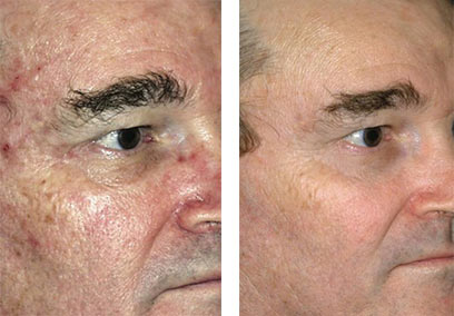 Sun Damage Removal Before & After