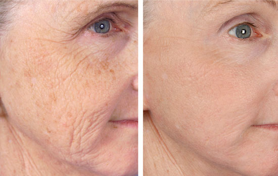 Wrinkle Reduction Before & After
