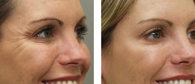 Botox Before & After