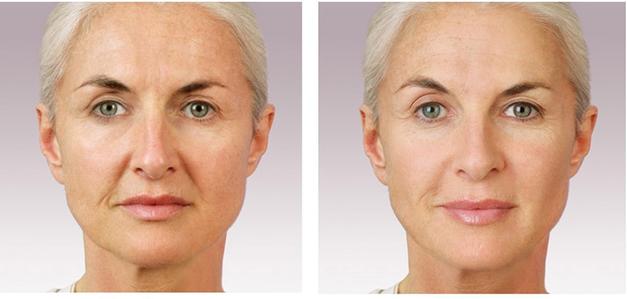 Juvederm Before & After