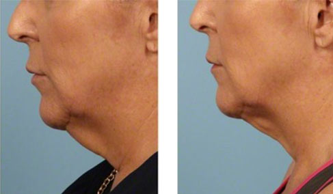 Kybella Before & After