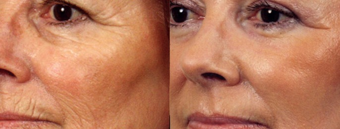 Laser Peel Before & After