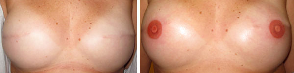 Breast Cancer survivors - Medical Tattooing Before & After