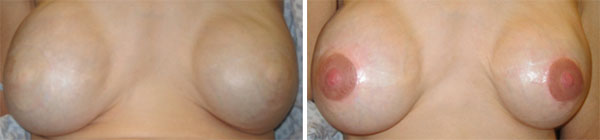 Breast Cancer survivors - Medical Tattooing Before & After