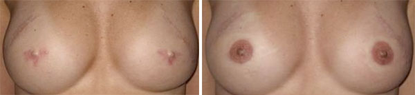 Breast Cancer survivors - Medical Tattooing Before & After