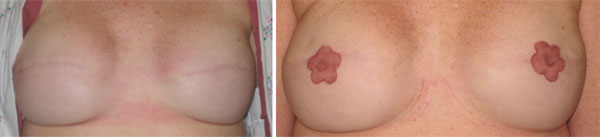 Breast Cancer survivors - Medical Tattooing Before & After