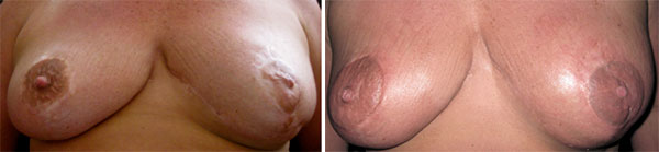 Breast Cancer survivors - Medical Tattooing Before & After