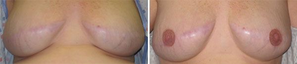 Breast Cancer survivors - Medical Tattooing Before & After