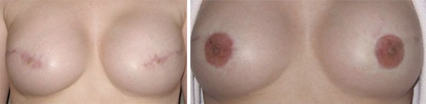 Breast Cancer survivors - Medical Tattooing Before & After