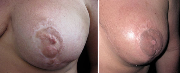 Breast Cancer survivors - Medical Tattooing Before & After