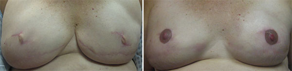 Breast Cancer survivors - Medical Tattooing Before & After