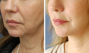 Non-Surgical Neck Tightening - Laser Aesthetics of Colorado