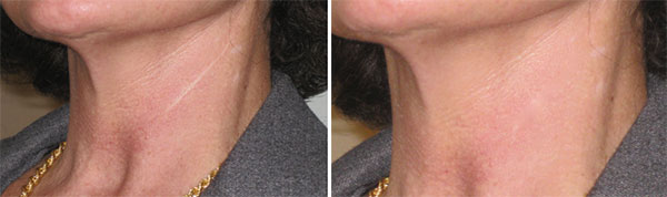 Permanent Makeup Before & After