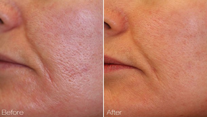 Facial Pore Reduction / Pore Stramning i Denver, Centennial Colorado