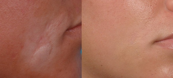 Scar Rejuvination Before & After