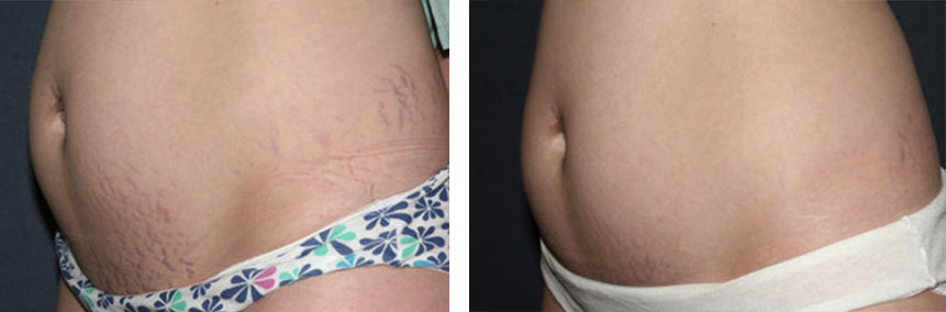 Stretch Mark Removal Before & After
