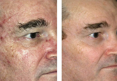 Facial excerizes for droopy eyelids