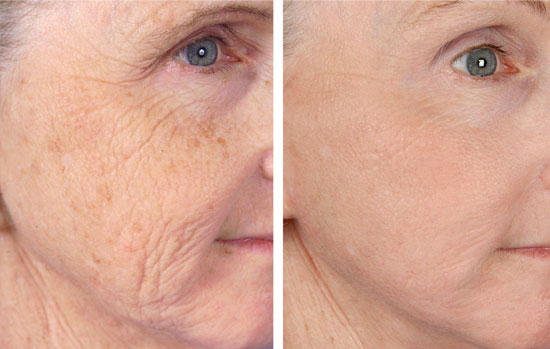 Effortless Anti-Aging: Cadence Cosmetics’ Wrinkle Reduction Treatments 